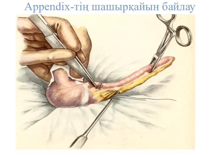 Appendix-тің шашырқайын байлау