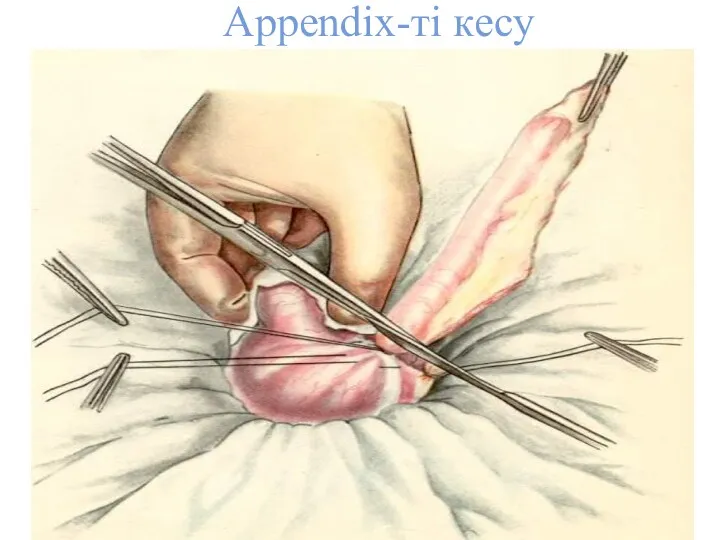 Appendix-ті кесу