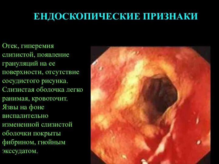 ЕНДОСКОПИЧЕСКИЕ ПРИЗНАКИ Отек, гиперемия слизистой, появление грануляций на ее поверхности,