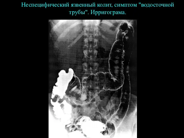 Неспецифический язвенный колит, симптом "водосточной трубы". Ирригограма.