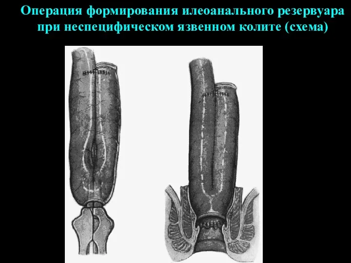 Операция формирования илеоанального резервуара при неспецифическом язвенном колите (схема)