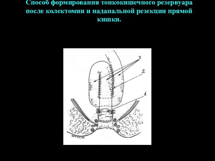 Способ формирования тонкокишечного резервуара после колектомии и наданальной резекции прямой кишки.