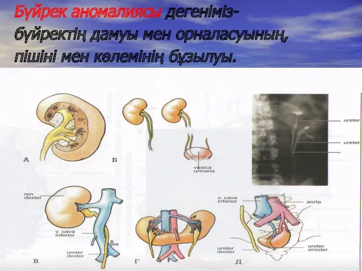 Бүйрек аномалиясы дегеніміз- бүйректің дамуы мен орналасуының, пішіні мен көлемінің бұзылуы.