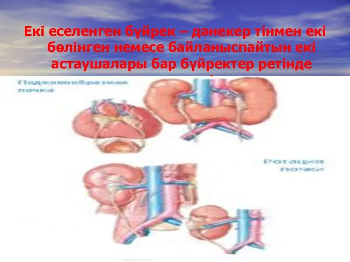 Екі еселенген бүйрек – дәнекер тінмен екі бөлінген немесе байланыспайтын екі астаушалары бар бүйректер ретінде кездеседі.