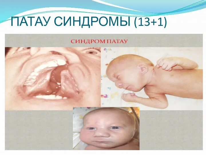 ПАТАУ СИНДРОМЫ (13+1)