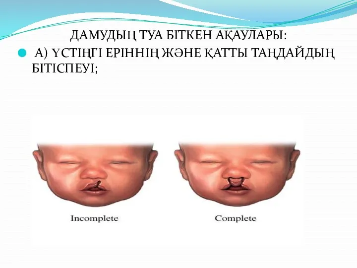 ДАМУДЫҢ ТУА БІТКЕН АҚАУЛАРЫ: А) ҮСТІҢГІ ЕРІННІҢ ЖӘНЕ ҚАТТЫ ТАҢДАЙДЫҢ БІТІСПЕУІ;