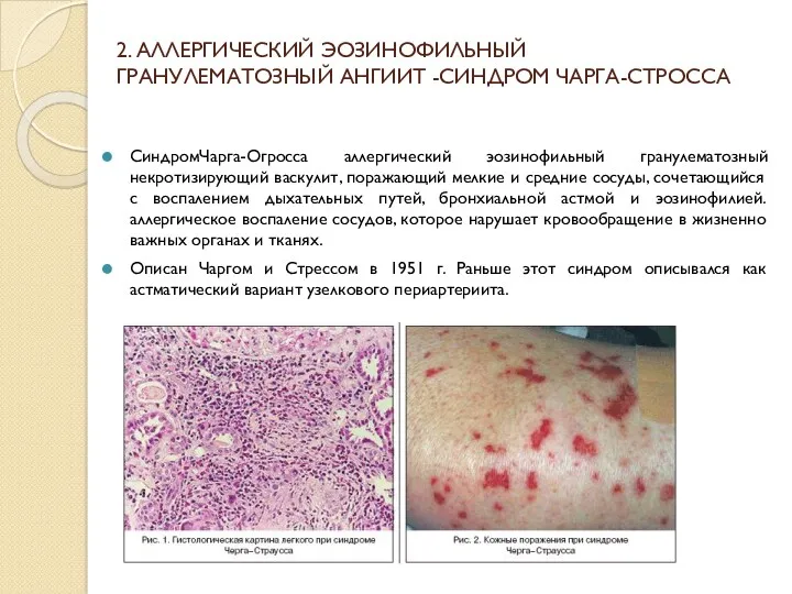 2. АЛЛЕРГИЧЕСКИЙ ЭОЗИНОФИЛЬНЫЙ ГРАНУЛЕМАТОЗНЫЙ АНГИИТ -СИНДРОМ ЧАРГА-СТРОССА СиндромЧарга-Огросса аллергический эозинофильный