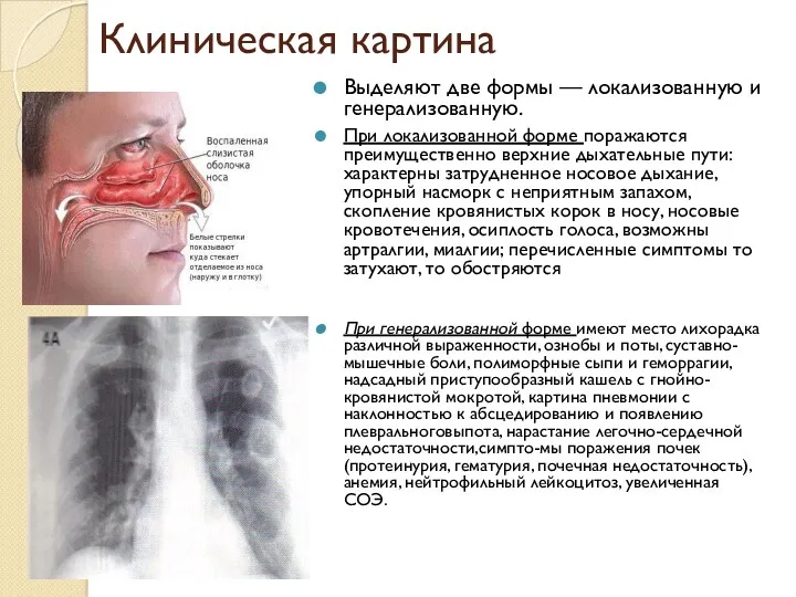 Клиническая картина Выделяют две формы — локализованную и генерализованную. При