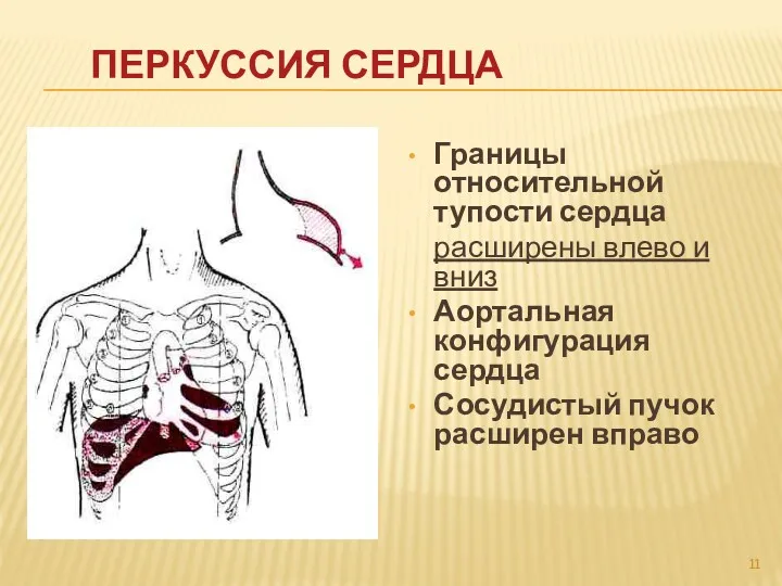 ПЕРКУССИЯ СЕРДЦА Границы относительной тупости сердца расширены влево и вниз