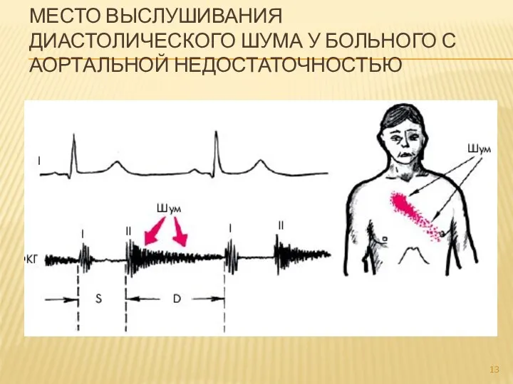 МЕСТО ВЫСЛУШИВАНИЯ ДИАСТОЛИЧЕСКОГО ШУМА У БОЛЬНОГО С АОРТАЛЬНОЙ НЕДОСТАТОЧНОСТЬЮ