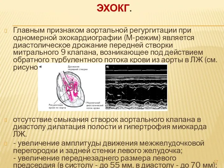 ЭХОКГ. Главным признаком аортальной регургитации при одномерной эхокардиографии (М-режим) является