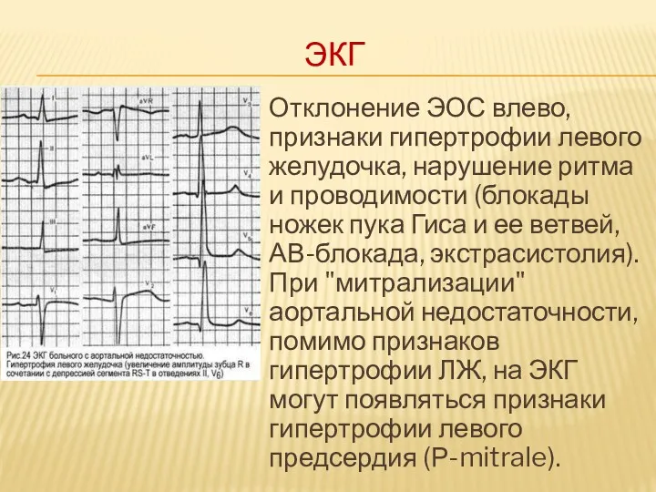 ЭКГ Отклонение ЭОС влево, признаки гипертрофии левого желудочка, нарушение ритма