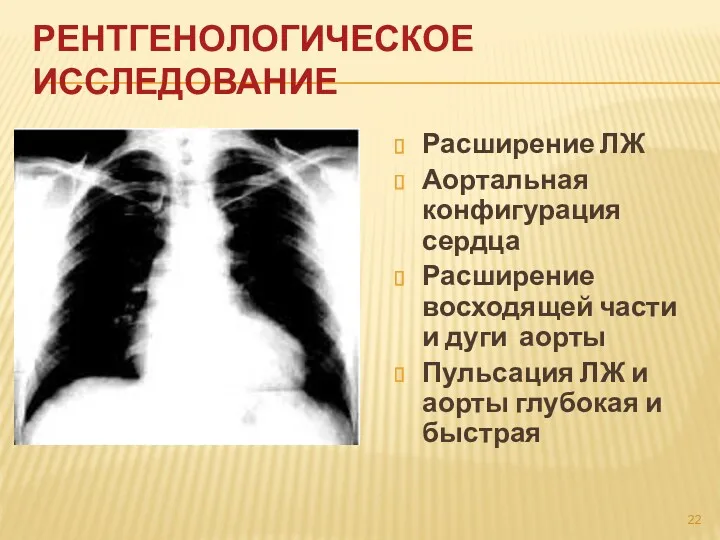 РЕНТГЕНОЛОГИЧЕСКОЕ ИССЛЕДОВАНИЕ Расширение ЛЖ Аортальная конфигурация сердца Расширение восходящей части