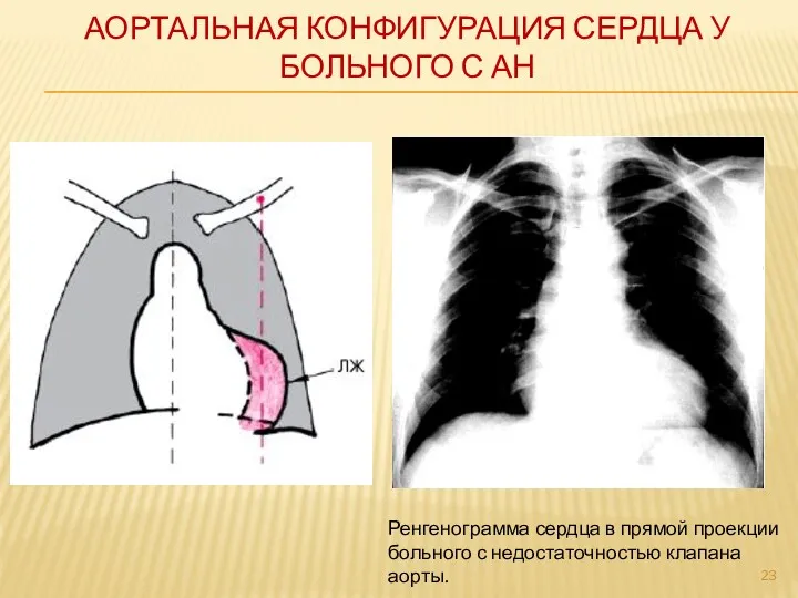 АОРТАЛЬНАЯ КОНФИГУРАЦИЯ СЕРДЦА У БОЛЬНОГО С АН Ренгенограмма сердца в