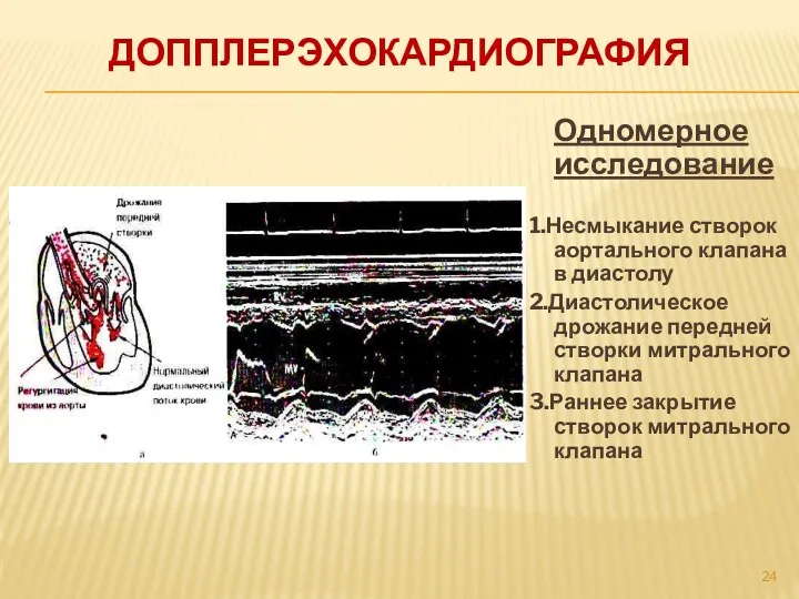 ДОППЛЕРЭХОКАРДИОГРАФИЯ Одномерное исследование 1.Несмыкание створок аортального клапана в диастолу 2.Диастолическое