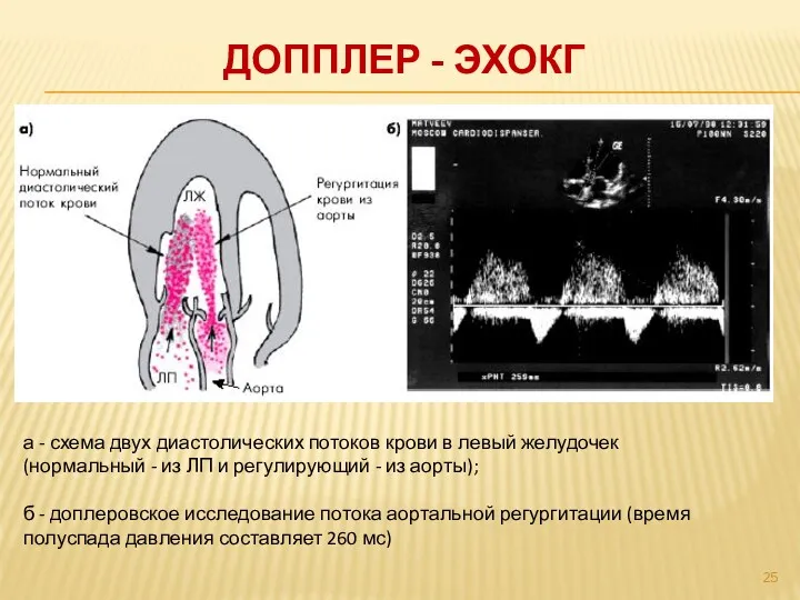 ДОППЛЕР - ЭХОКГ а - схема двух диастолических потоков крови