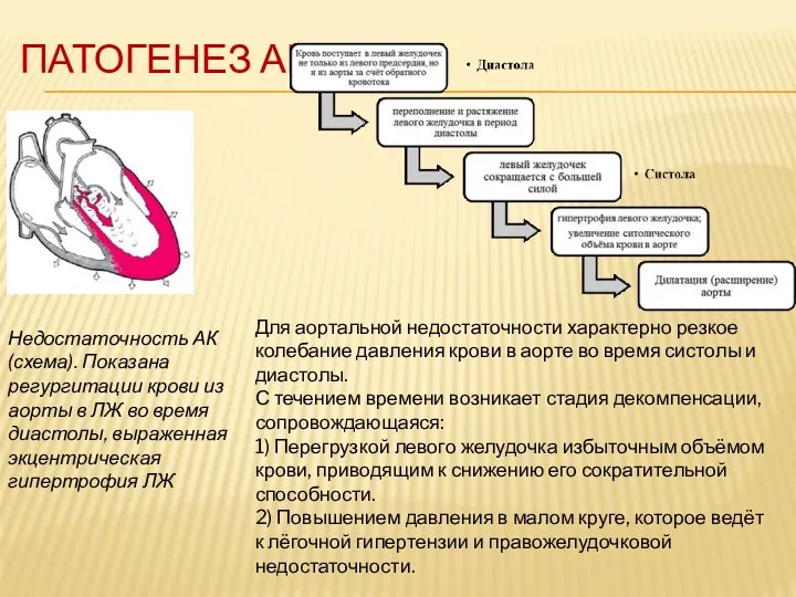 ПАТОГЕНЕЗ АН Недостаточность АК (схема). Показана регургитации крови из аорты