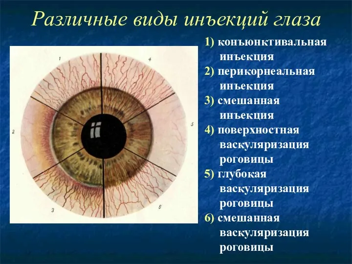 Различные виды инъекций глаза 1) конъюнктивальная инъекция 2) перикорнеальная инъекция