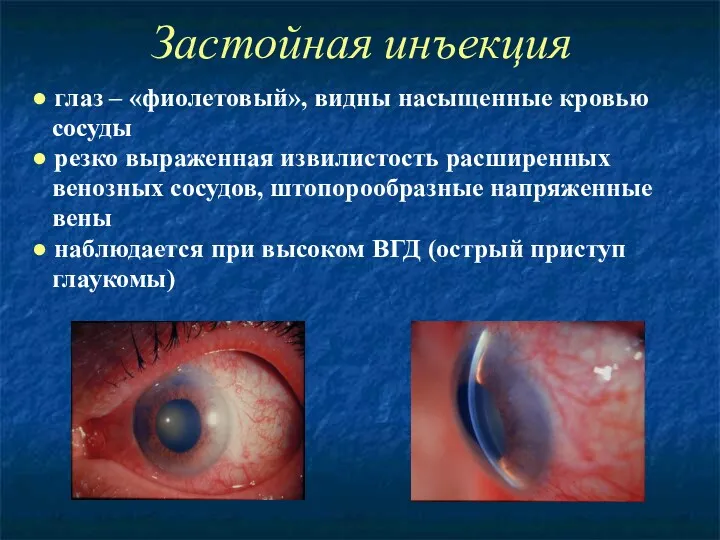 Застойная инъекция ● глаз – «фиолетовый», видны насыщенные кровью сосуды