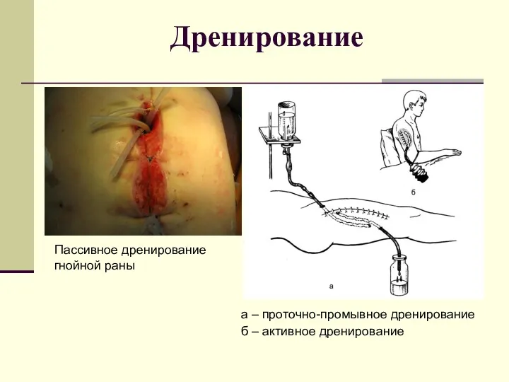 Дренирование Пассивное дренирование гнойной раны а – проточно-промывное дренирование б – активное дренирование