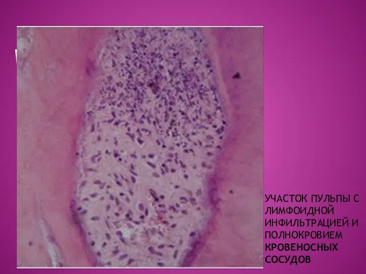 УЧАСТОК ПУЛЬПЫ С ЛИМФОИДНОЙ ИНФИЛЬТРАЦИЕЙ И ПОЛНОКРОВИЕМ КРОВЕНОСНЫХ СОСУДОВ Ораска гемотоксилин-эозин