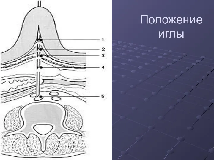 Положение иглы