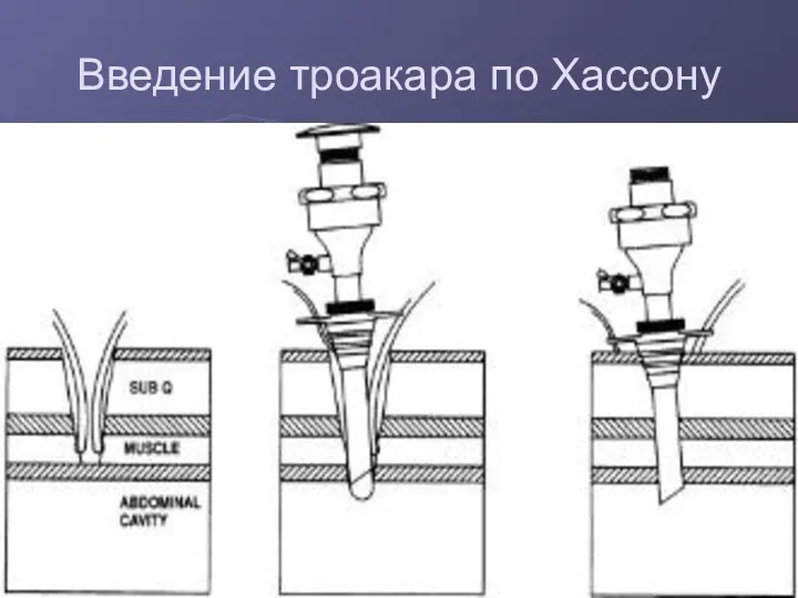 Введение троакара по Хассону