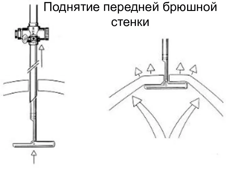 Поднятие передней брюшной стенки