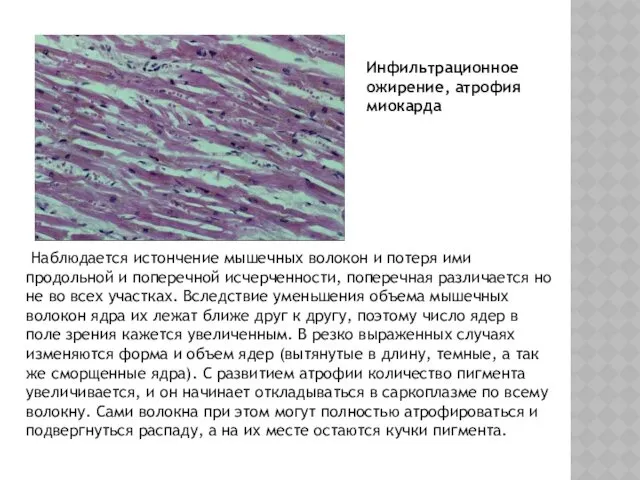 Инфильтрационное ожирение, атрофия миокарда Наблюдается истончение мышечных волокон и потеря