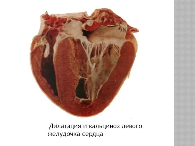 Дилатация и кальциноз левого желудочка сердца