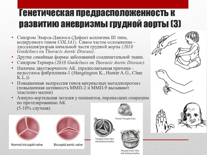 Синдром Элерса-Данлоса (Дефект коллагена III типа, кодируемого геном COL3A1). Самое