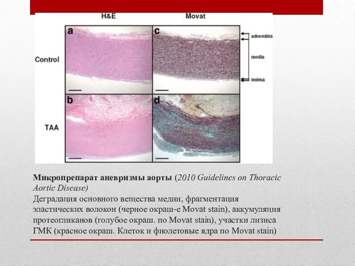 Микропрепарат аневризмы аорты (2010 Guidelines on Thoracic Aortic Disease) Деградация