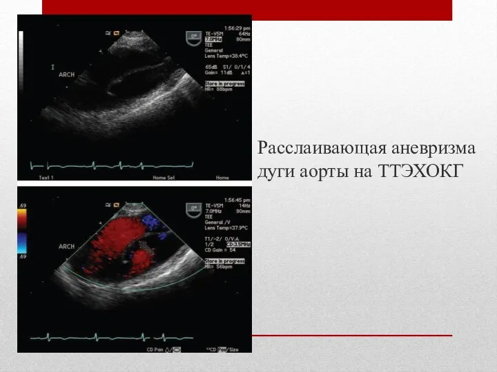 Расслаивающая аневризма дуги аорты на ТТЭХОКГ
