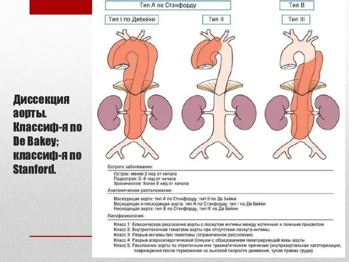 Диссекция аорты. Классиф-я по De Bakey; классиф-я по Stanford.
