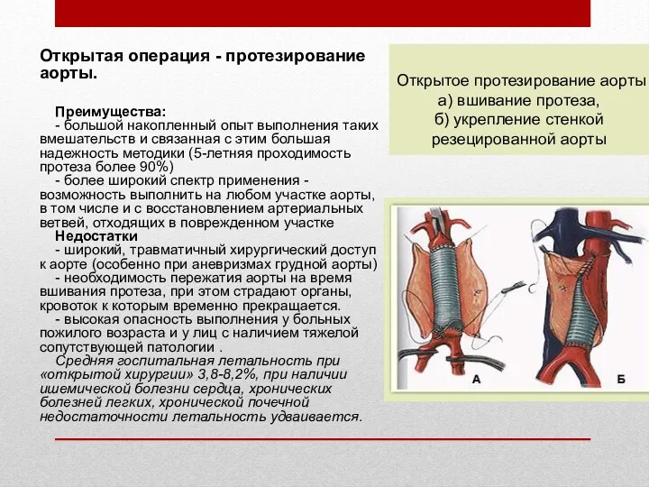 Открытая операция - протезирование аорты. Преимущества: - большой накопленный опыт