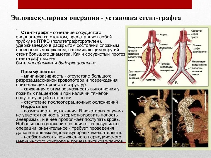 Эндоваскулярная операция - установка стент-графта . Стент-графт - сочетание сосудистого