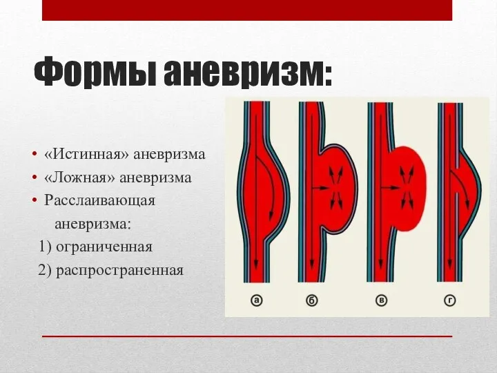 Формы аневризм: «Истинная» аневризма «Ложная» аневризма Расслаивающая аневризма: 1) ограниченная 2) распространенная