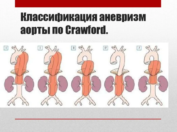 Классификация аневризм аорты по Crawford.