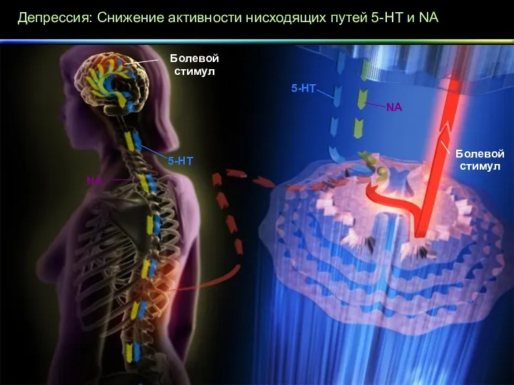 Депрессия: Снижение активности нисходящих путей 5-HT и NA Болевой стимул NA 5-HT 5-HT NA Болевой стимул