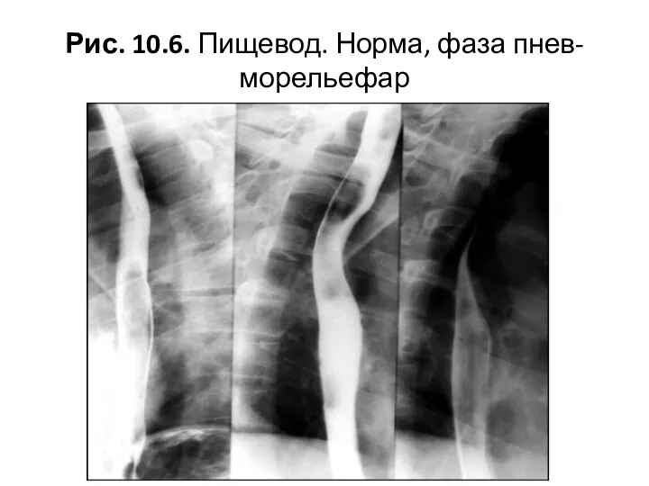 Рис. 10.6. Пищевод. Норма, фаза пнев-морельефар