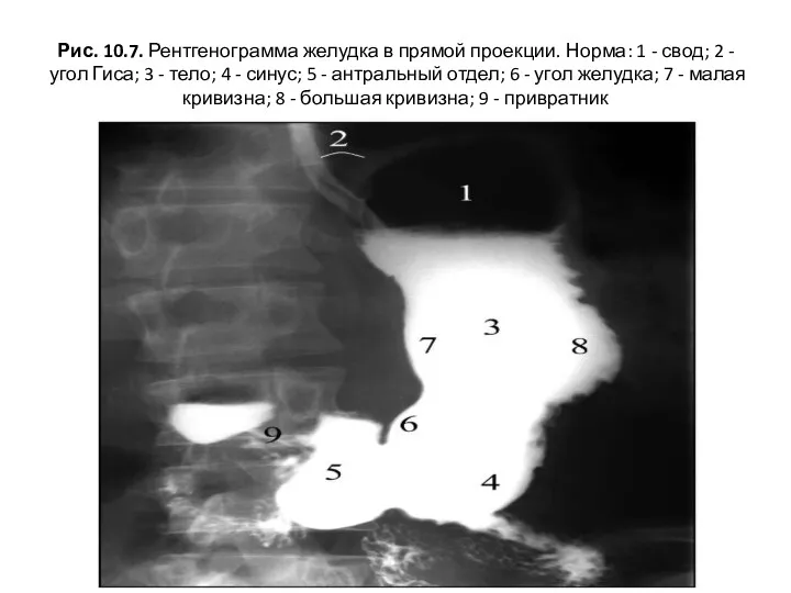 Рис. 10.7. Рентгенограмма желудка в прямой проекции. Норма: 1 -