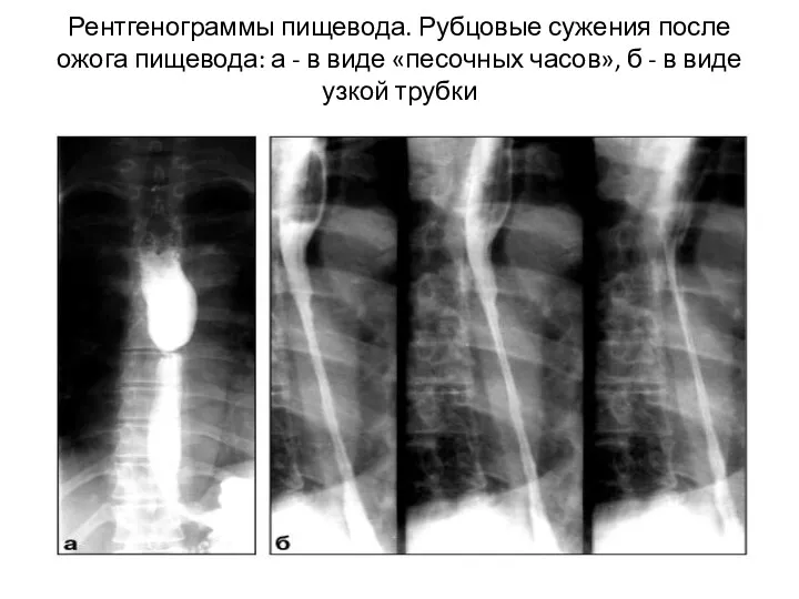 Рентгенограммы пищевода. Рубцовые сужения после ожога пищевода: а - в