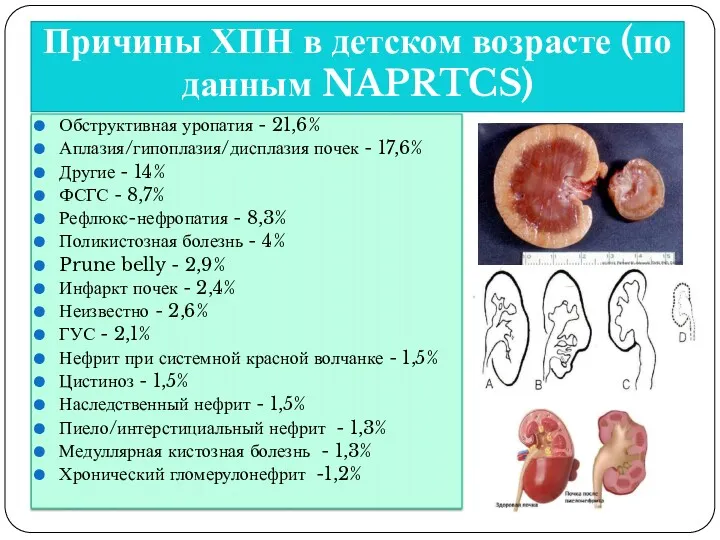 Причины ХПН в детском возрасте (по данным NAPRTCS) Обструктивная уропатия