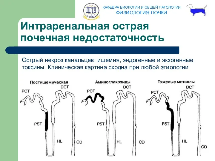 Интраренальная острая почечная недостаточность Острый некроз канальцев: ишемия, эндогенные и