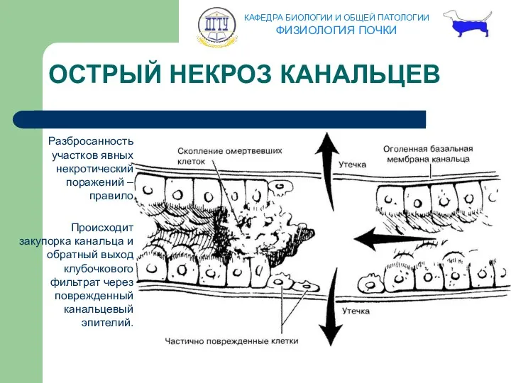 ОСТРЫЙ НЕКРОЗ КАНАЛЬЦЕВ Разбросанность участков явных некротический поражений – правило