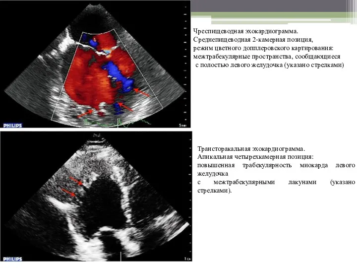 Чреспищеводная эхокардиограмма. Среднепищеводная 2-камерная позиция, режим цветного допплеровского картирования: межтрабекулярные