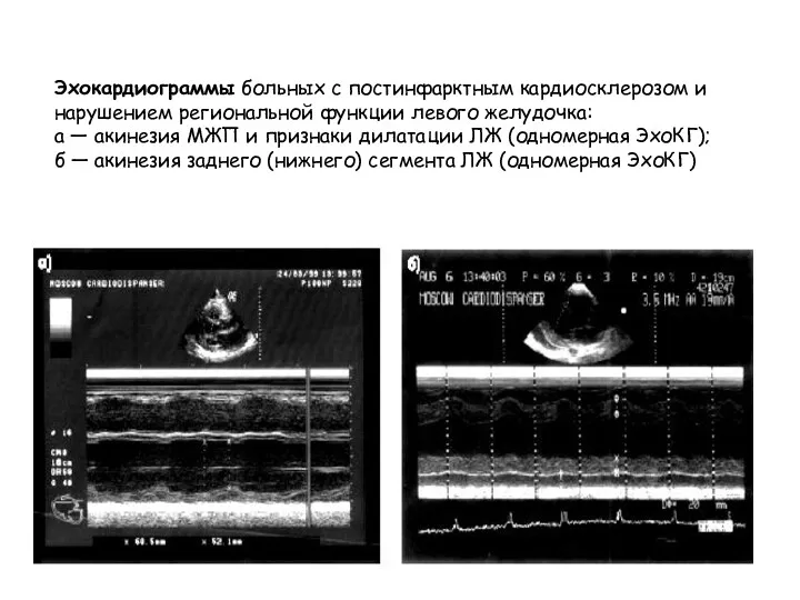Эхокардиограммы больных с постинфарктным кардиосклерозом и нарушением региональной функции левого