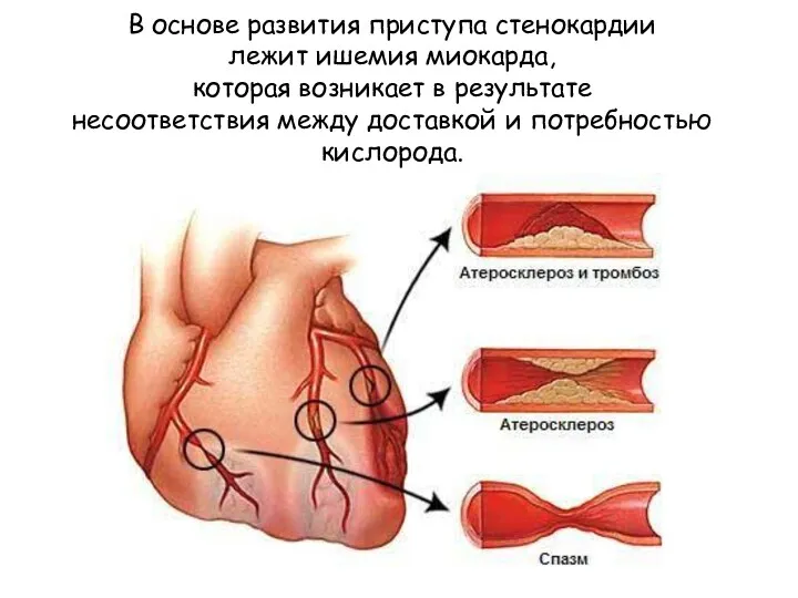 В основе развития приступа стенокардии лежит ишемия миокарда, которая возникает