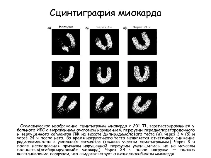 Сцинтиграфия миокарда Схематическое изображение сцинтиграмм миокарда с 201 Т1, зарегистрированных
