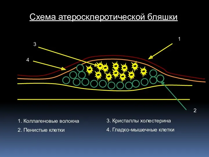 Схема атеросклеротической бляшки 1. Коллагеновые волокна 2. Пенистые клетки 3.